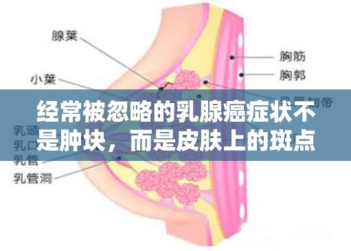 经常被忽略的乳腺癌症状不是肿块，而是皮肤上的斑点